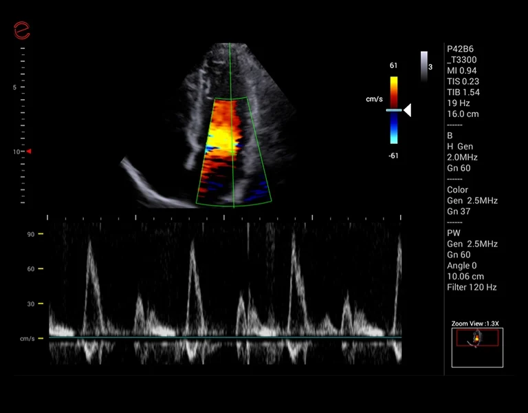 MyLab™X1 Go - CV Doppler