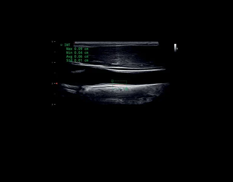 esaote MyLab™X1 – Obliczanie IMT tętnicy szyjnej