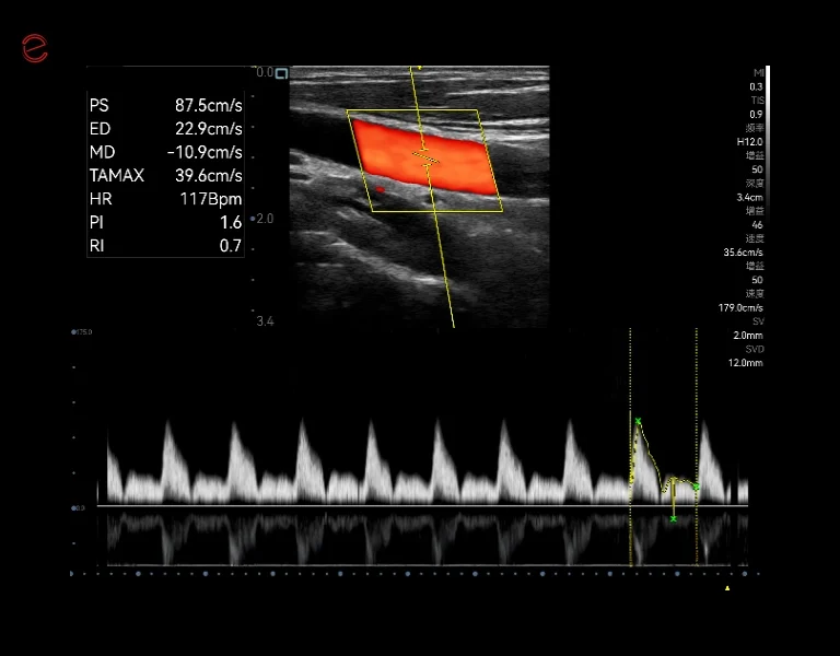 cv Vascular