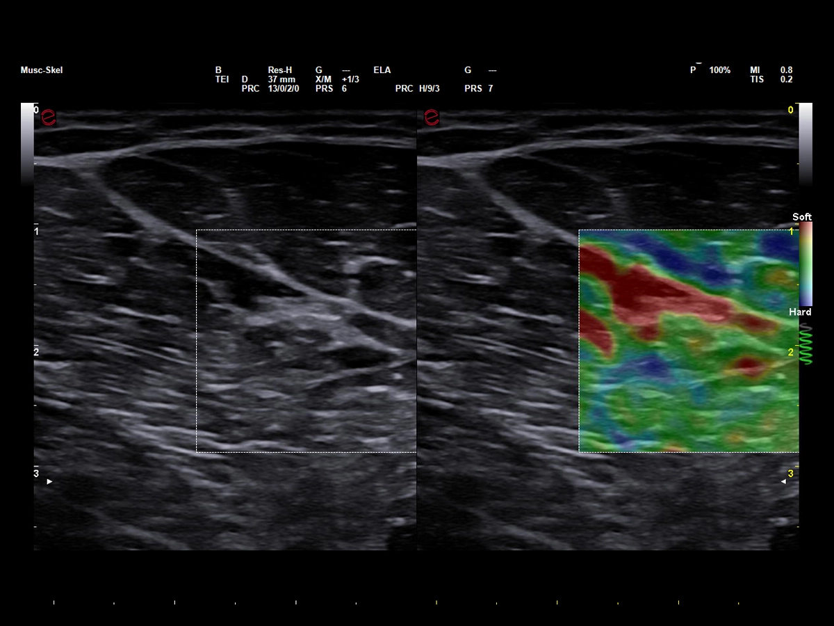 Elastosonografia