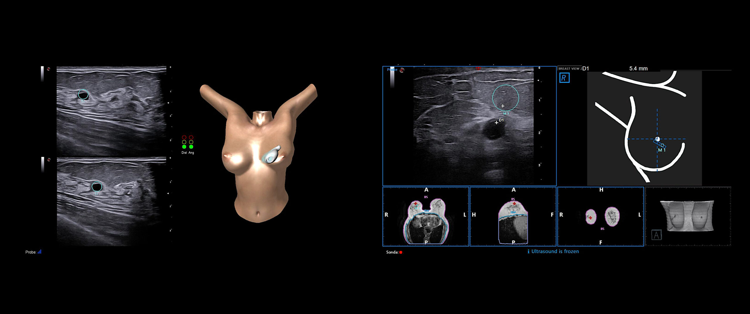 badanie piersi z wykorzystaniem technologii breastnav